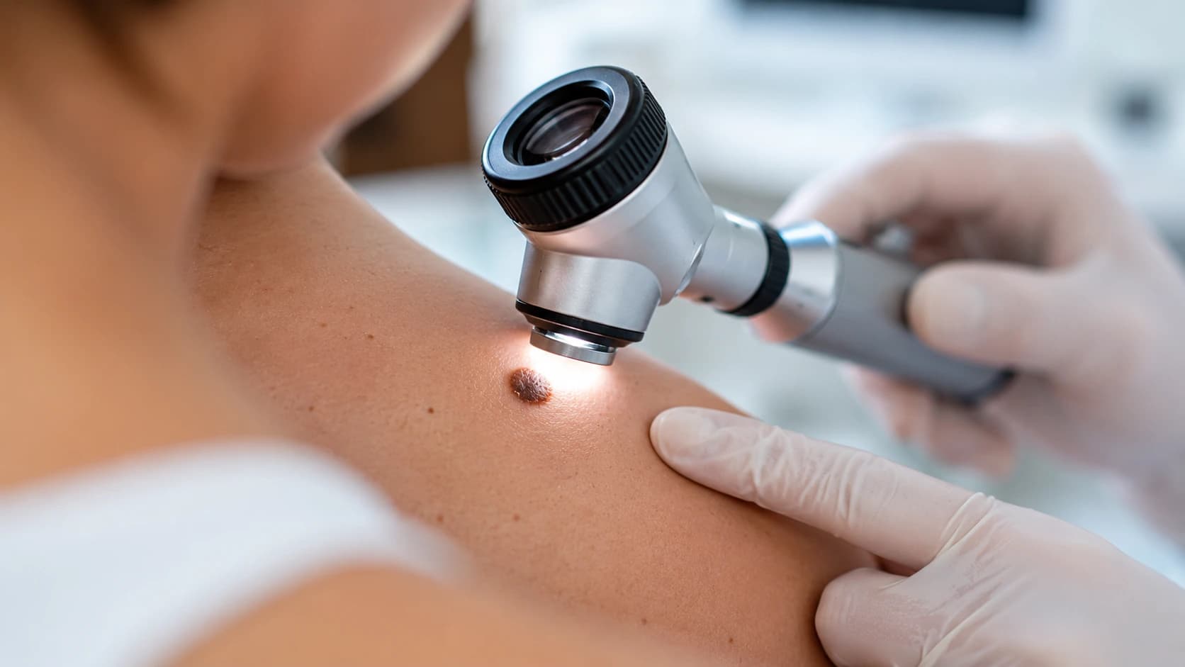 Grain de beauté : la méthode ABCDE pour reconnaître les signes qui doivent alerter
